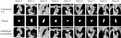 Integrating Clinical Data and Attentional CT Imaging Features for Esophageal Fistula Prediction in Esophageal Cancer